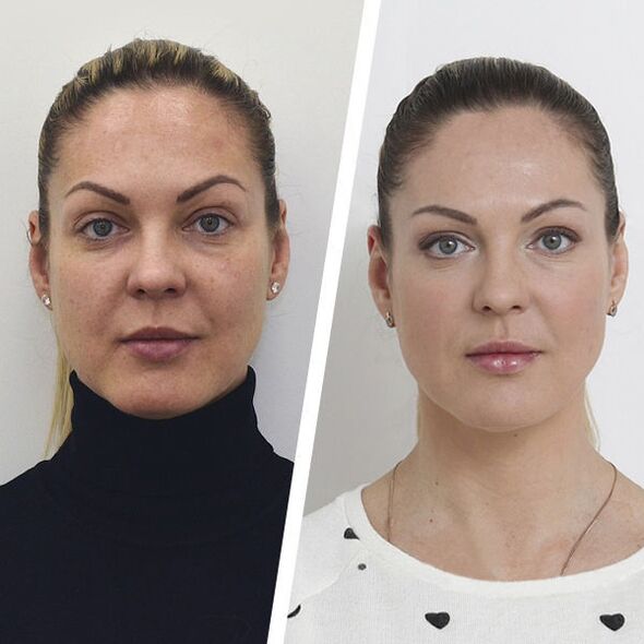 Antes y después del rejuvenecimiento de la piel del rostro sin cirugía.