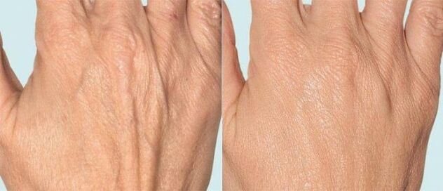 Piel de la mano antes y después de la terapia fraccionada.