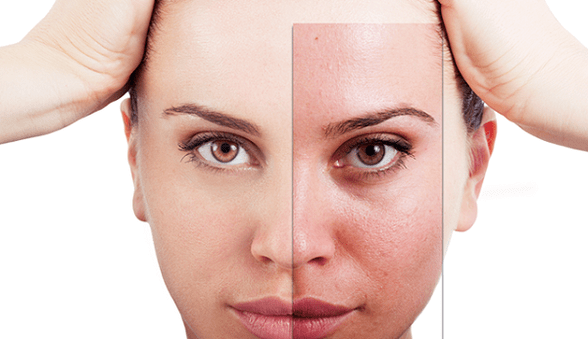 El rejuvenecimiento fraccionado elimina los principales defectos estéticos del rostro