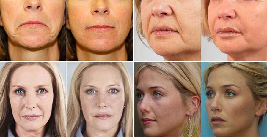 fotos de mujeres antes y después del rejuvenecimiento de la piel facial