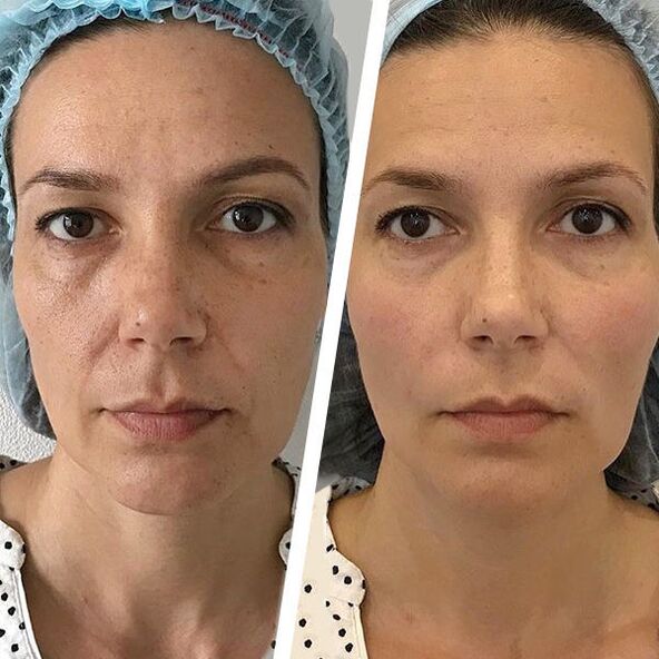 fotos faciales antes y después del rejuvenecimiento con láser