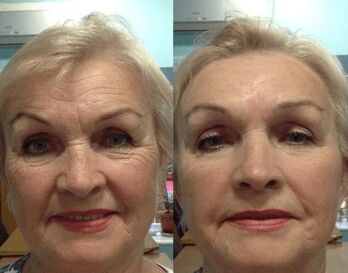 experiencia con la crema antiarrugas Goji Cream - fotos personales antes y después